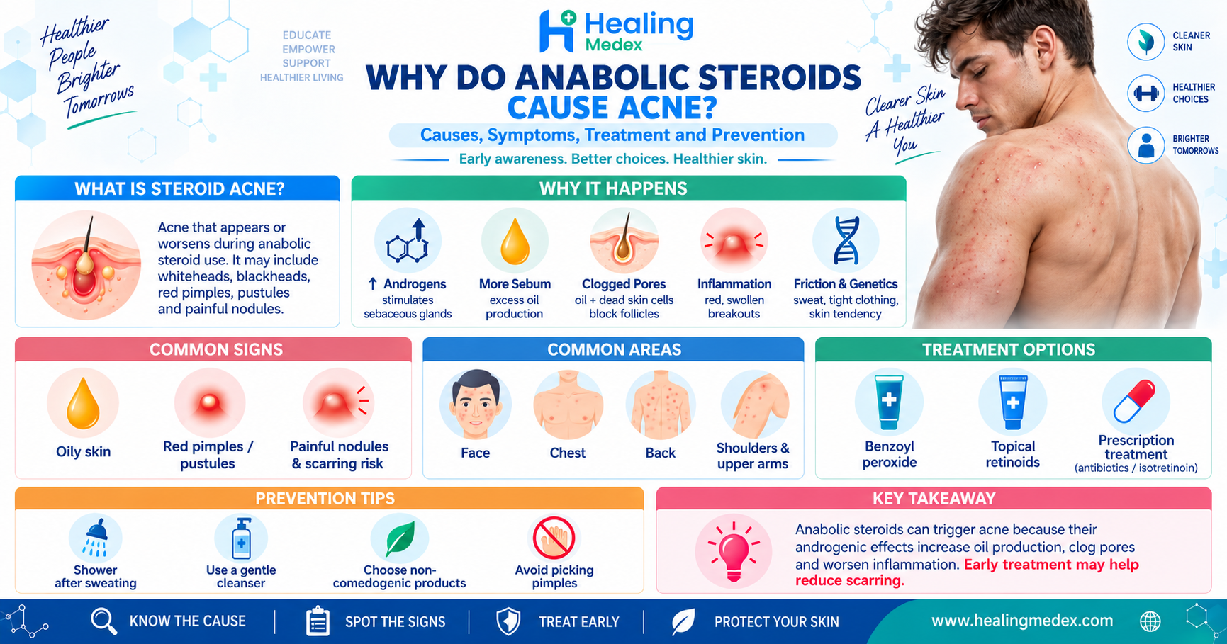 Why Do Anabolic Steroids Cause Acne?